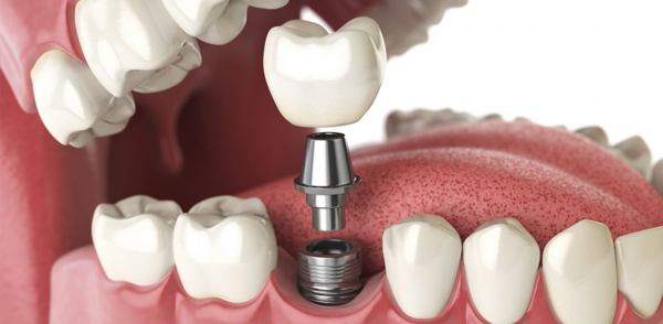 Cấy Răng Implant Tức Thì: Ưu Điểm, Điều Kiện & Quy Trình Thực Hiện - ảnh 4