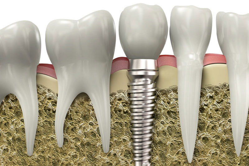 Trồng Răng Implant Dentium Mỹ Có Tốt Không? Giá Bao Nhiêu? - ảnh 3