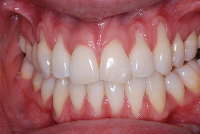 Niềng Răng Bị Hở Chân Răng: Nguyên Nhân Và Cách Khắc Phục - ảnh 2