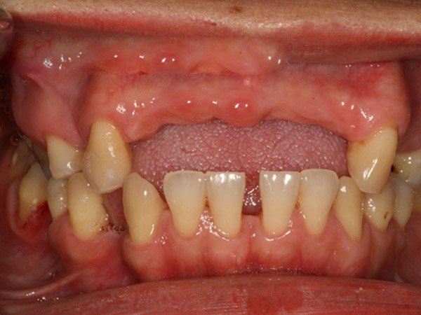 Trồng Răng Implant Bao Lâu Thì Lành? – Nha Khoa Quốc Tế Á Châu - ảnh 3