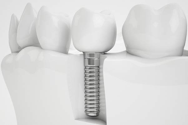 Trồng Răng Implant Bao Lâu Thì Lành? – Nha Khoa Quốc Tế Á Châu - ảnh 1