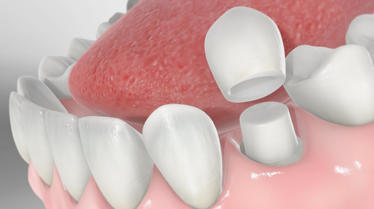 Bọc Răng Sứ Có Bị Sâu Răng Không? – Nha Khoa Quốc Tế Á Châu - ảnh 1