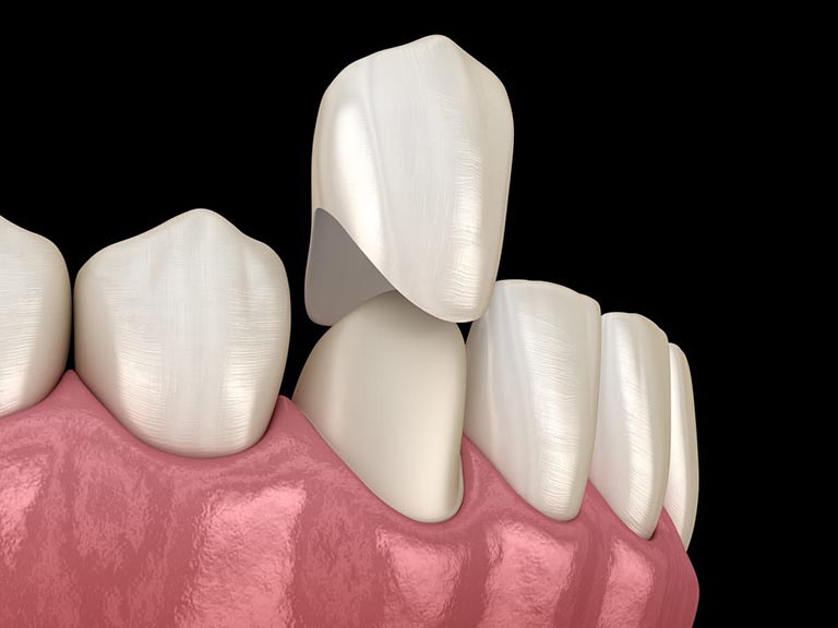 Bọc Răng Sứ Có Bị Sâu Răng Không? – Nha Khoa Quốc Tế Á Châu - ảnh 2