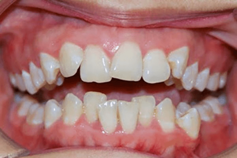 Bọc Răng Sứ Có Bị Sâu Răng Không? – Nha Khoa Quốc Tế Á Châu - ảnh 4