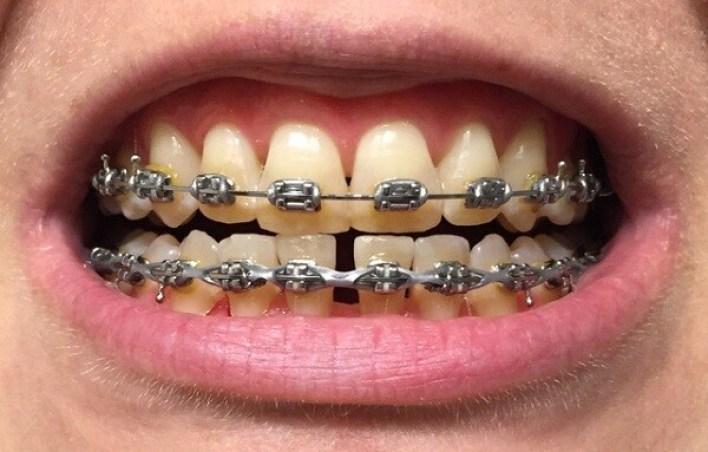 Niềng Răng Xong Có Nên Tẩy Trắng Răng? – Bác Sĩ Giải Đáp! - ảnh 3