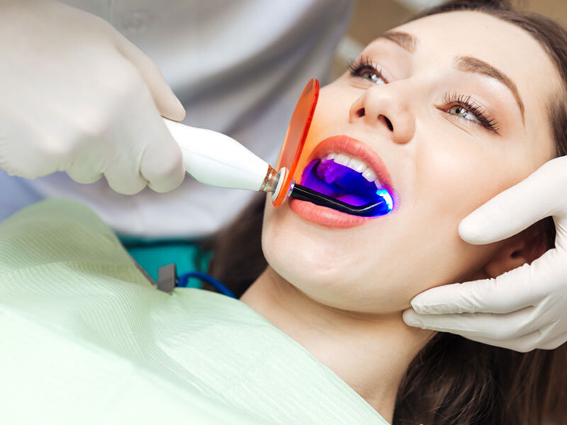 Niềng Răng Xong Có Nên Tẩy Trắng Răng? – Bác Sĩ Giải Đáp! - ảnh 2