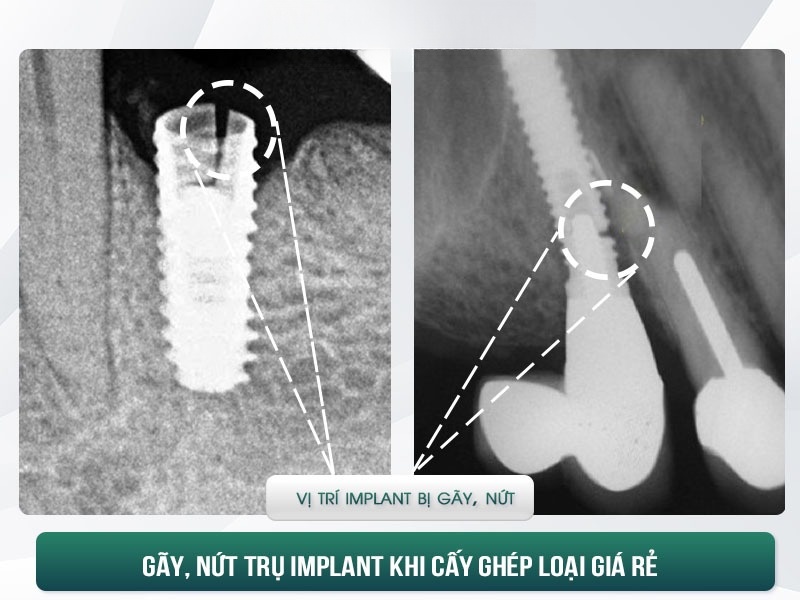 Hối Hận Khi Trồng Răng Implant Giá Rẻ - "Tiền Mất Tật Mang" - ảnh 6