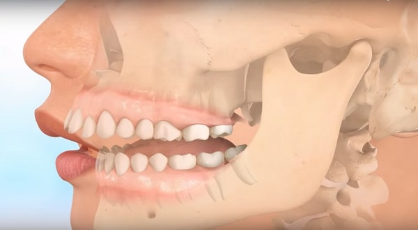Bọc răng sứ có tốt không - ảnh 5