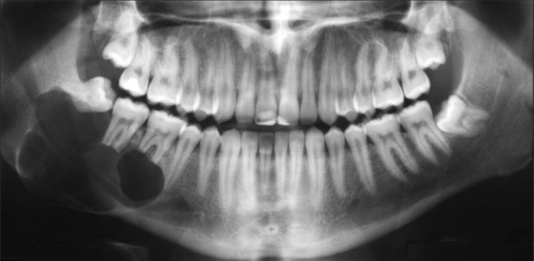 U Nang Chân Răng: Nguyên Nhân, Triệu Chứng Và Cách Điều Trị - ảnh 4