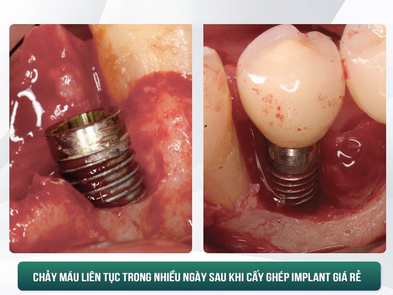 Hối Hận Khi Trồng Răng Implant Giá Rẻ - "Tiền Mất Tật Mang" - ảnh 4