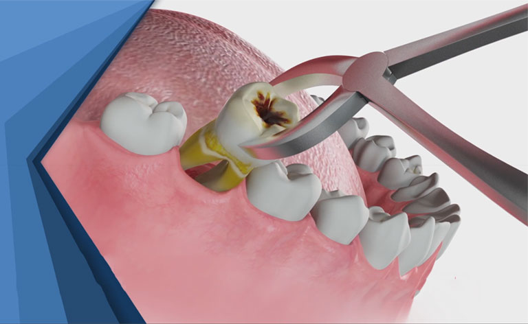 Hỏi Đáp: Nhổ Răng Sâu Giá Bao Nhiêu? – Ảnh 4