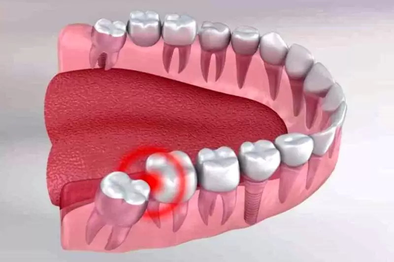 Đau Răng Hàm Dưới: Nguyên Nhân Và Cách Điều Trị Hiệu Quả - ảnh 5