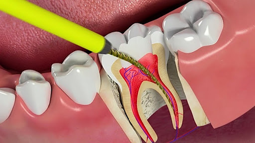 Triệt Tủy Răng Bọc Sứ Giá Bao Nhiêu? - ảnh 4