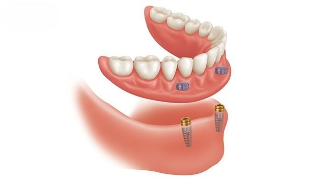 Răng Hàm Tháo Lắp Là Gì? Loại Nào Tốt? Giá Bao Nhiêu? - ảnh 5