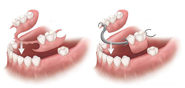 Răng Cửa Giả Tháo Lắp Có Ưu Điểm Gì? Giá Bao Nhiêu Tiền? - ảnh 4