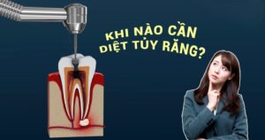 [Hỏi Đáp]: Khi Nào Cần Diệt Tủy Răng? Giá Bao Nhiêu?