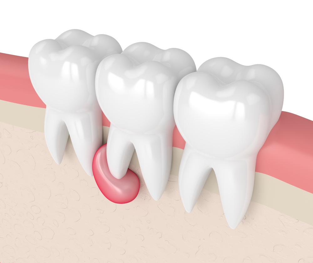 U Nang Chân Răng: Nguyên Nhân, Triệu Chứng Và Cách Điều Trị - ảnh 3