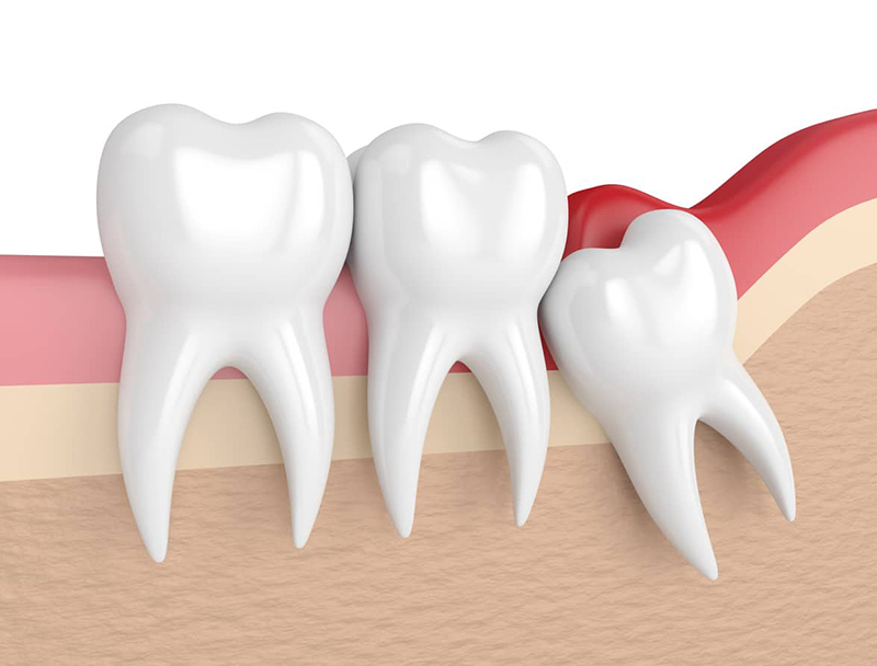 Đau Răng Số 8 Phải Làm Sao? Có Nhổ Được Hay Không? - ảnh 3