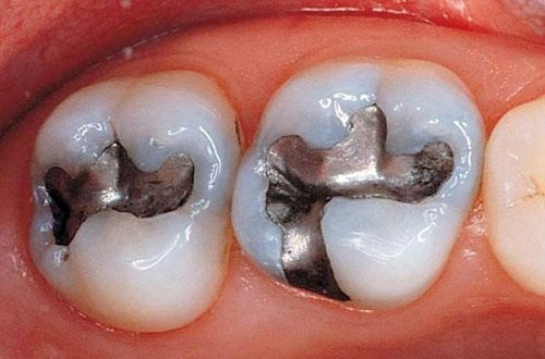 Trám Răng Bằng Amalgam Có Tốt Không? Giá Bao Nhiêu? - ảnh 5