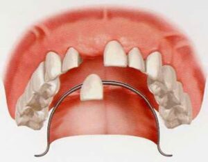 Răng Cửa Giả Tháo Lắp Có Ưu Điểm Gì? Giá Bao Nhiêu Tiền?