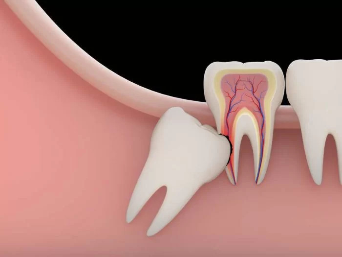 Đau Răng Số 8 Phải Làm Sao? Có Nhổ Được Hay Không? - ảnh 2