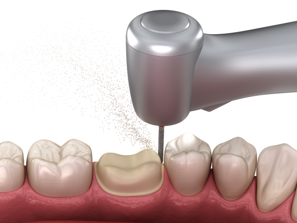 Răng Sứ Có Tốt Bằng Răng Thật Không? – [Bác Sĩ Giải Đáp] - ảnh 2