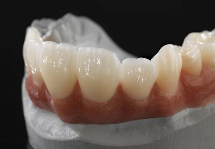 Răng sứ 3 triệu nên chọn loại nào để đảm bảo chất lượng?