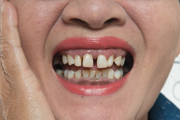 Răng bị va đập mạnh có thể gây mất thẩm mỹ không?
