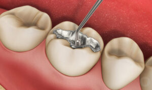 Trám Răng Bằng Amalgam Có Tốt Không? Giá Bao Nhiêu?