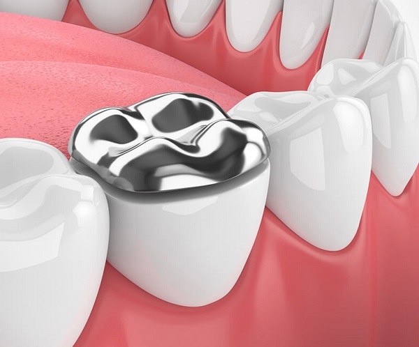 Trám Răng Bằng Amalgam Có Tốt Không? Giá Bao Nhiêu? - ảnh 6