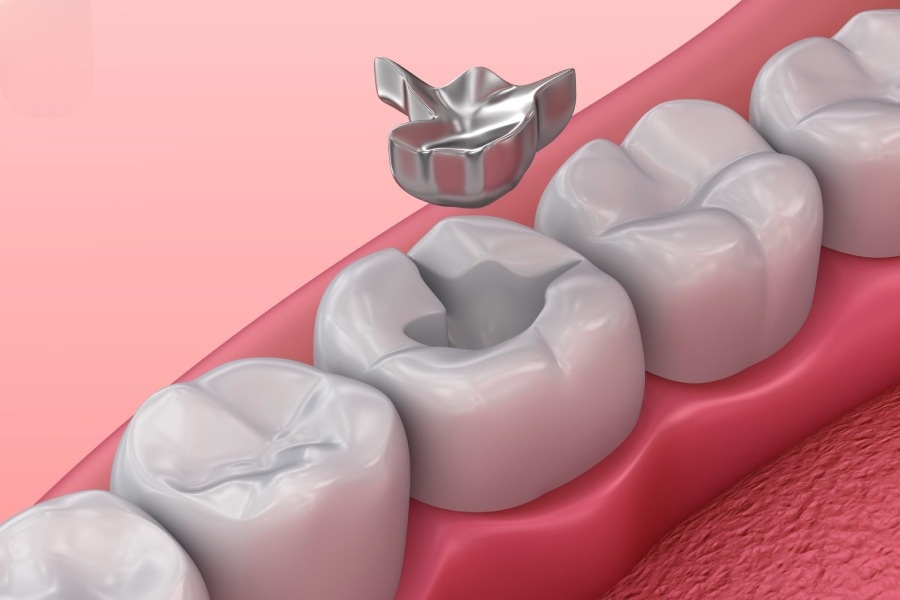 Trám Răng Bằng Amalgam Có Tốt Không? Giá Bao Nhiêu? - ảnh 4