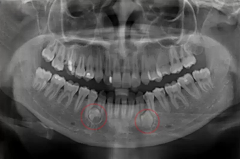 U Nang Chân Răng: Nguyên Nhân, Triệu Chứng Và Cách Điều Trị - ảnh 1