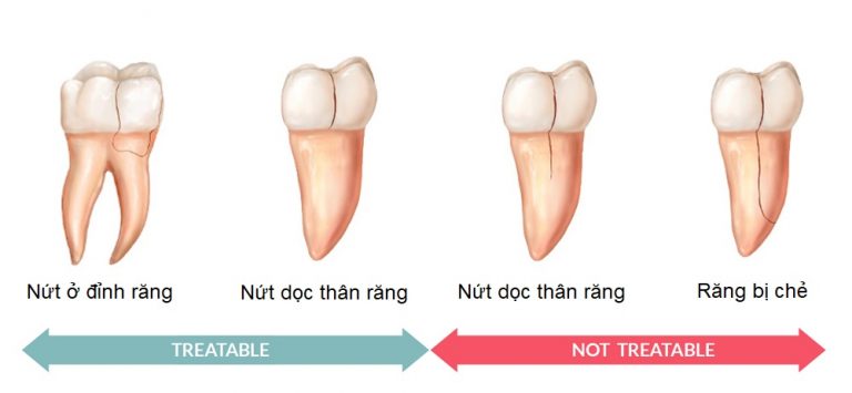 Nứt Răng Số 7 Gây Đau Nhức Ê Buốt Phải Làm Sao? - ảnh 5