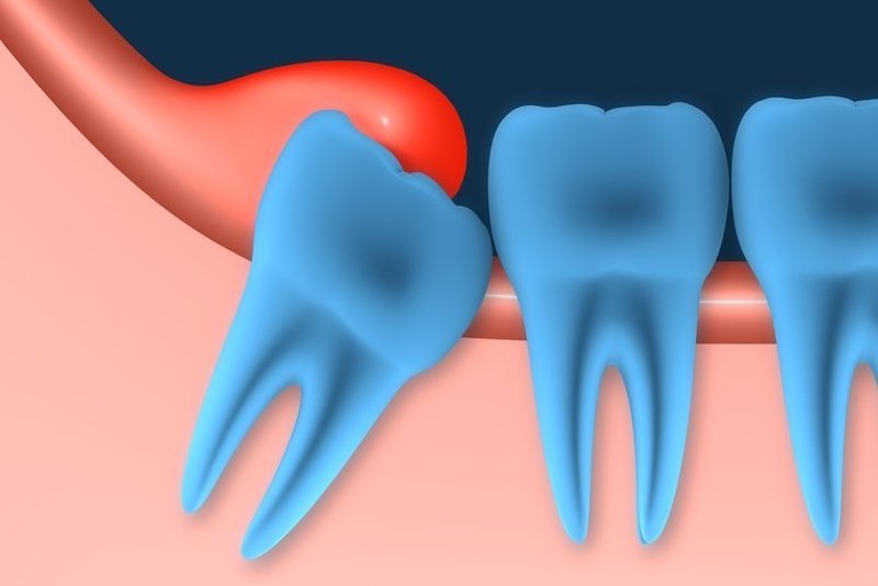 Chi Phí Cắt Lợi Thẩm Mỹ Bao Nhiêu Tiền? - ảnh 5