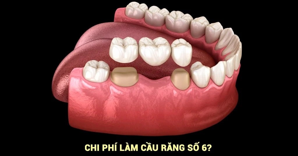 Làm Cầu Răng Số 6 Có Tốt Không? Có Bền Không? Giá Bao Nhiêu? - ảnh 7