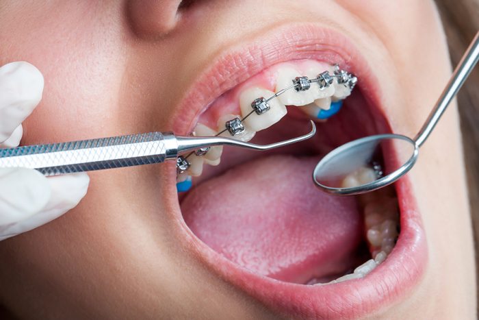 Có Niềng Răng 15 Triệu Hay Không? – Nha Khoa Quốc Tế Á Châu - ảnh 4