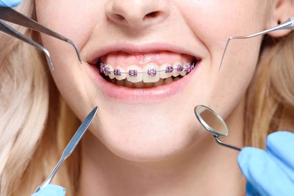 Có Niềng Răng 15 Triệu Hay Không? – Nha Khoa Quốc Tế Á Châu - ảnh 3