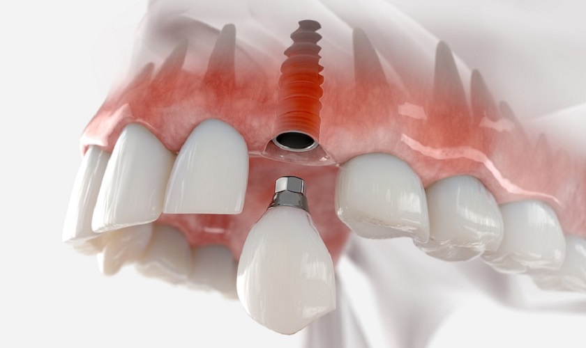 Trồng Răng Implant Tức Thì: Điều Kiện Và Quy Trình Thực Hiện - ảnh 4