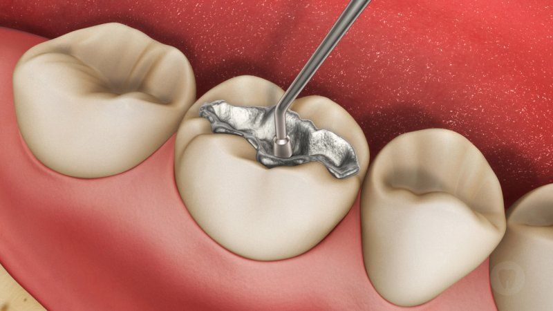 Bọc Răng Số 6 Có Tốt Không? Giá Bao Nhiêu? - ảnh 6