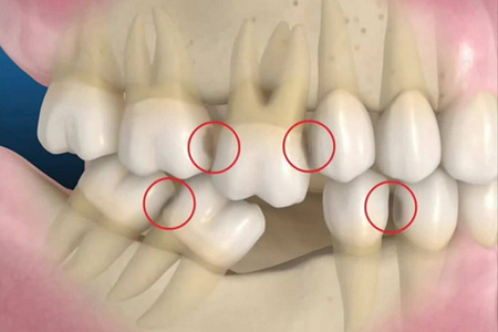 [Hỏi Đáp]: Răng Nào Quan Trọng Nhất Trên Hàm Răng Của Bạn? - ảnh 6