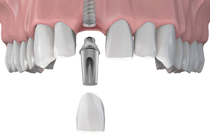 Trồng Răng Implant Tức Thì: Điều Kiện Và Quy Trình Thực Hiện - ảnh 3