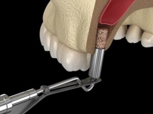 Kỹ Thuật Nâng Xoang Kín Và Nâng Xoang Hở Trong Cấy Implant