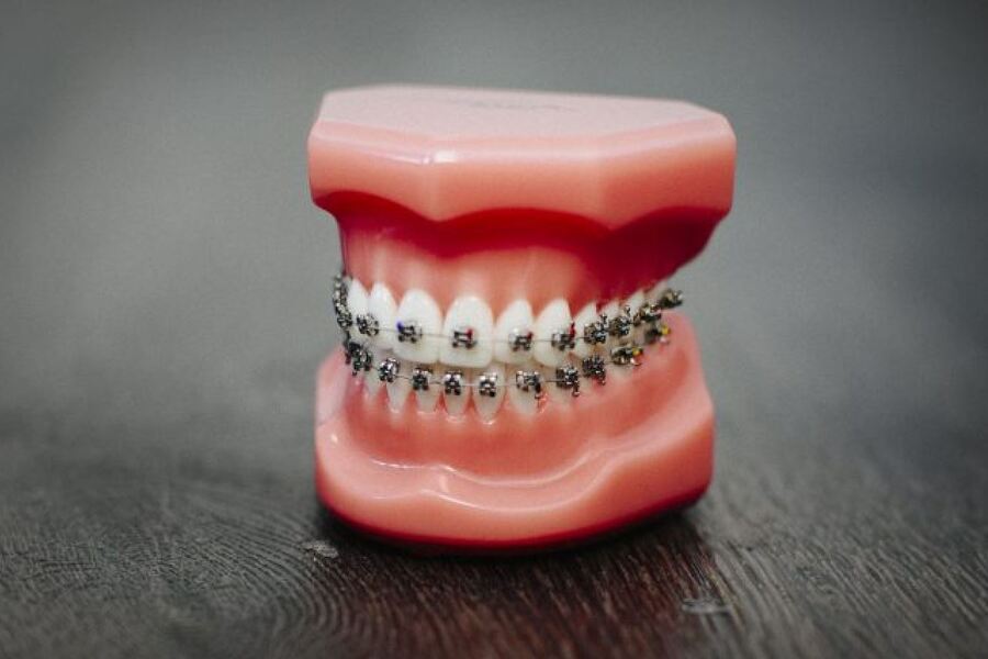 Có Niềng Răng 15 Triệu Hay Không? – Nha Khoa Quốc Tế Á Châu - ảnh 7