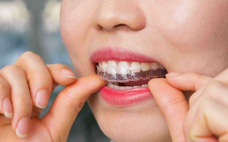 Có Niềng Răng 15 Triệu Hay Không? – Nha Khoa Quốc Tế Á Châu - ảnh 6