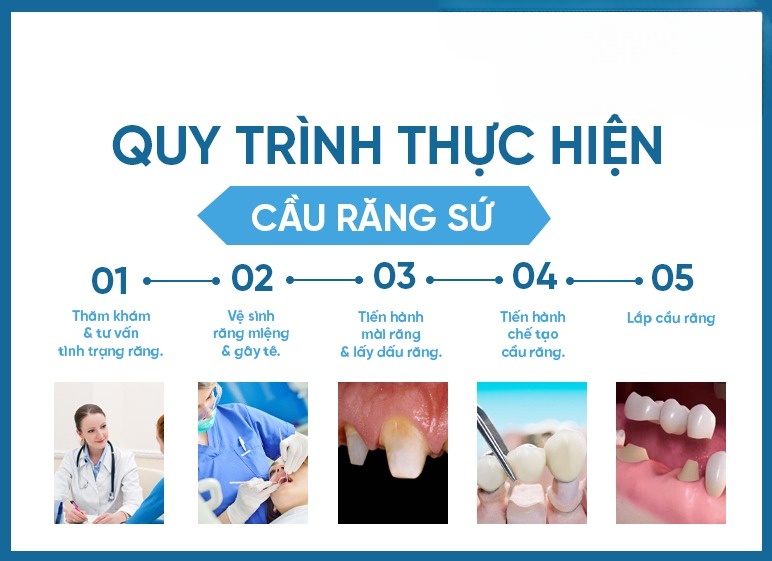 Làm Cầu Răng Số 5 Có Tốt Không? Có Bền Không? Giá Bao Nhiêu? - ảnh 7