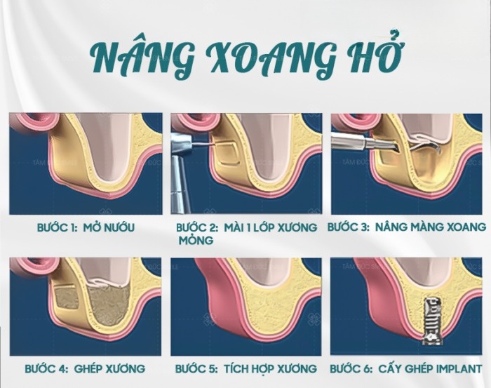 Kỹ Thuật Nâng Xoang Kín Và Nâng Xoang Hở Trong Cấy Implant - ảnh 8