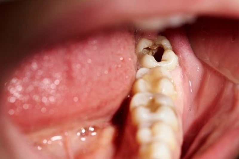 Có Niềng Răng 15 Triệu Hay Không? – Nha Khoa Quốc Tế Á Châu - ảnh 5