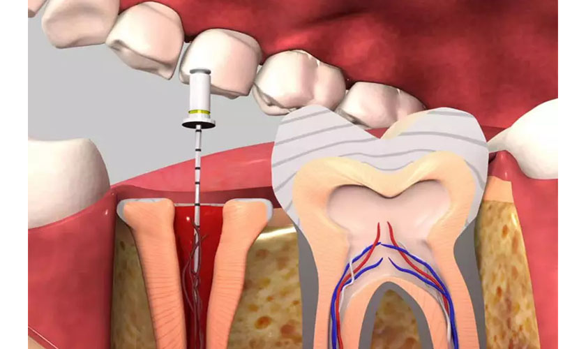 Bọc Răng Số 6 Có Tốt Không? Giá Bao Nhiêu? - ảnh 4