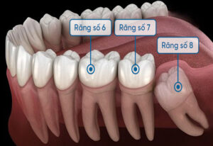 Cách Xử Lý Răng Số 7 Bị Lung Lay Sau Khi Nhổ Răng Khôn Số 8