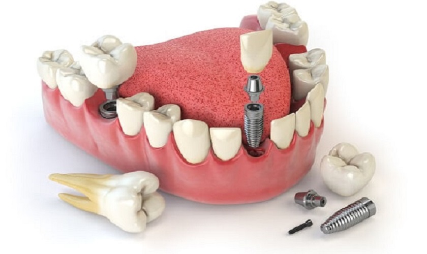Trồng Răng Implant Tức Thì: Điều Kiện Và Quy Trình Thực Hiện - ảnh 5